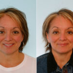 Botox® Cosmetic before and after photos in Houston, TX, Patient 27057