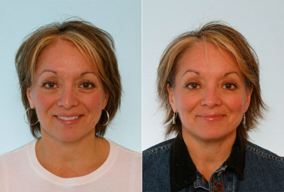 Xeomin / Botox® Cosmetic before and after photos in Houston, TX