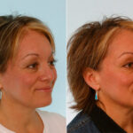 Botox® Cosmetic before and after photos in Houston, TX, Patient 27057