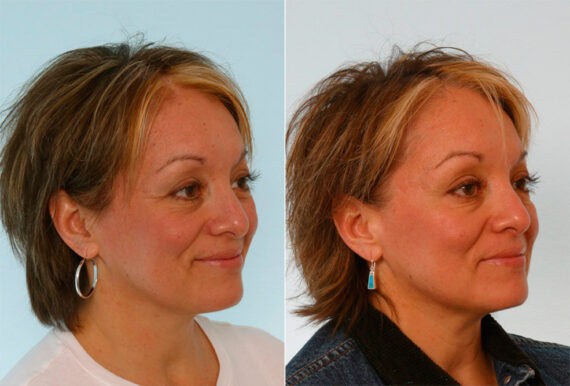 Xeomin / Botox® Cosmetic before and after photos in Houston, TX, Patient 27057