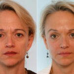 Botox® Cosmetic before and after photos in Houston, TX, Patient 27062