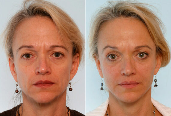 Xeomin / Botox® Cosmetic before and after photos in Houston, TX