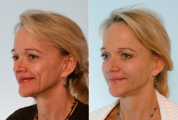 Xeomin / Botox® Cosmetic before and after photos in Houston, TX, Patient 27062