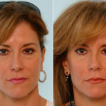 Botox® Cosmetic before and after photos in Houston, TX, Patient 27067