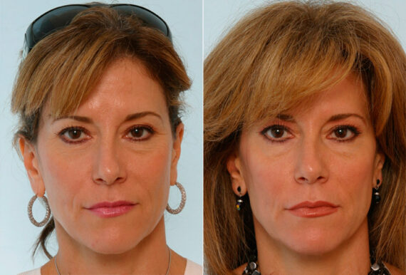 Xeomin / Botox® Cosmetic before and after photos in Houston, TX, Patient 27067