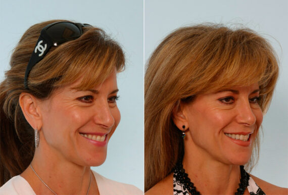 Xeomin / Botox® Cosmetic before and after photos in Houston, TX, Patient 27067