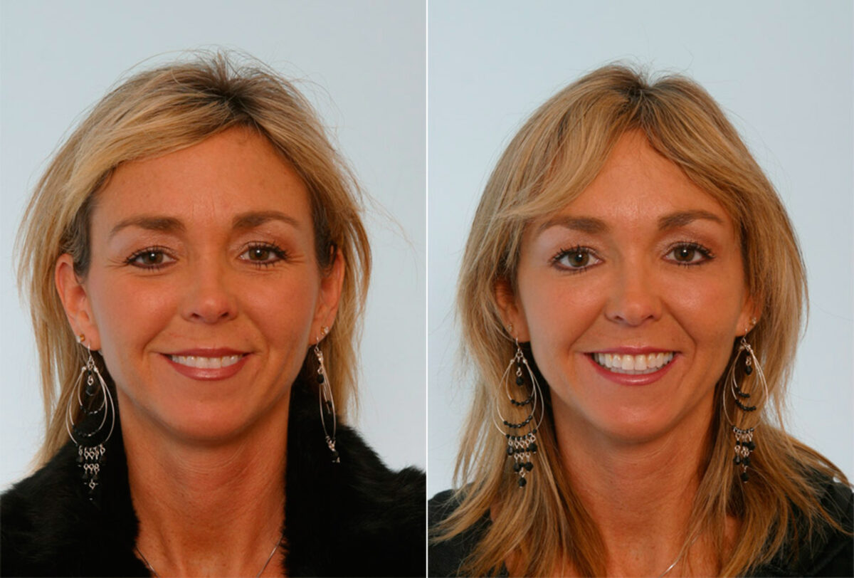 Botox® Cosmetic before and after photos in Houston, TX, Patient 27072