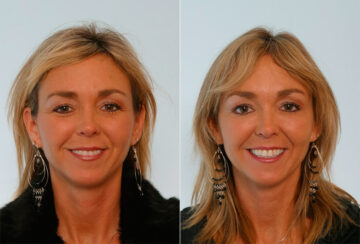 Xeomin / Botox® Cosmetic before and after photos in Houston, TX, Patient 27072