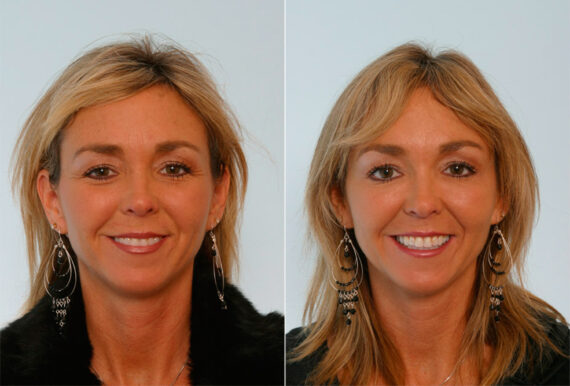 Xeomin / Botox® Cosmetic before and after photos in Houston, TX, Patient 27072