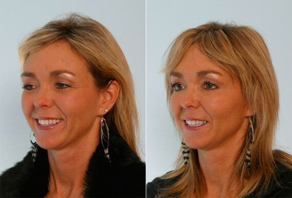 Xeomin / Botox® Cosmetic before and after photos in Houston, TX, Patient 27072