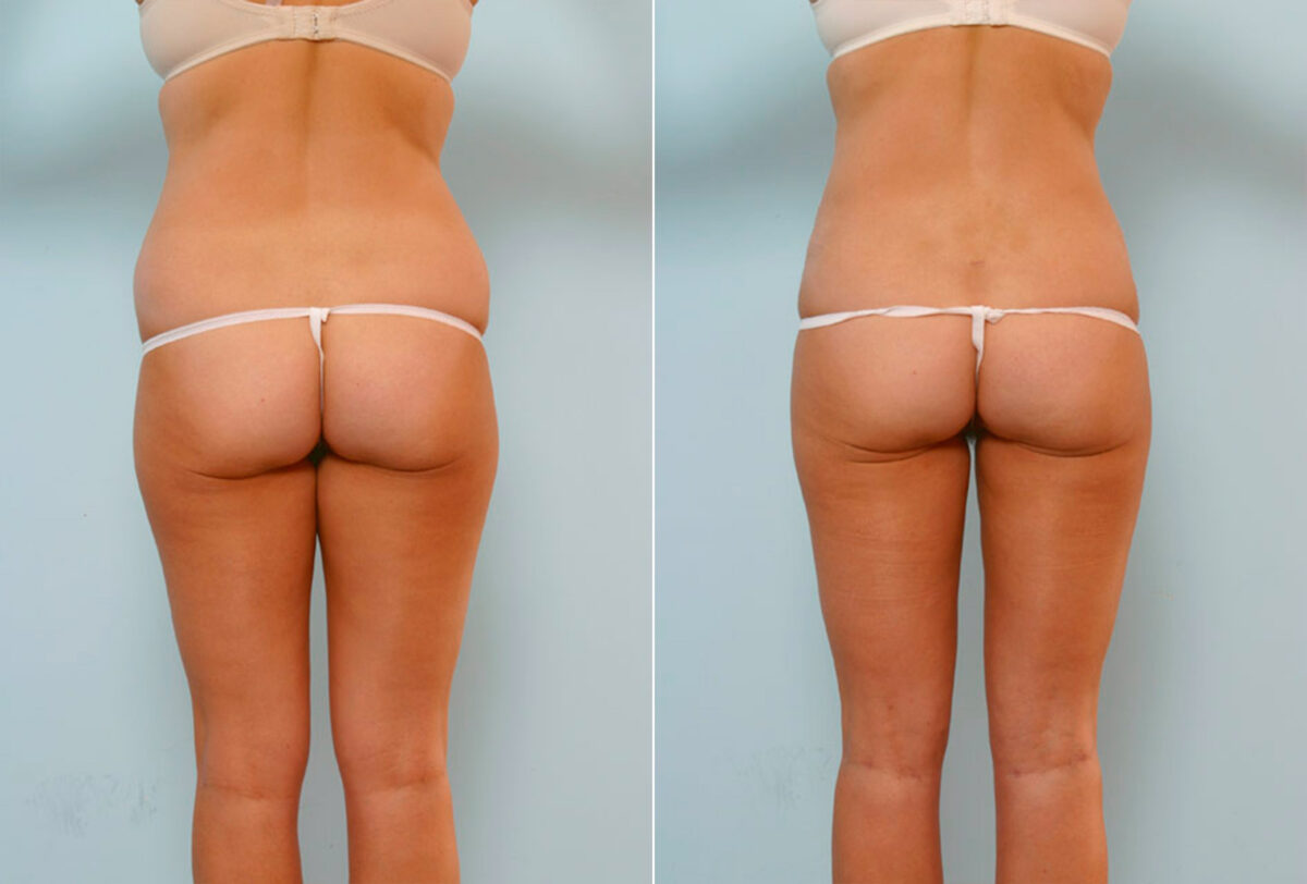 Abdominoplasty before and after photos in Houston, TX, Patient 24480