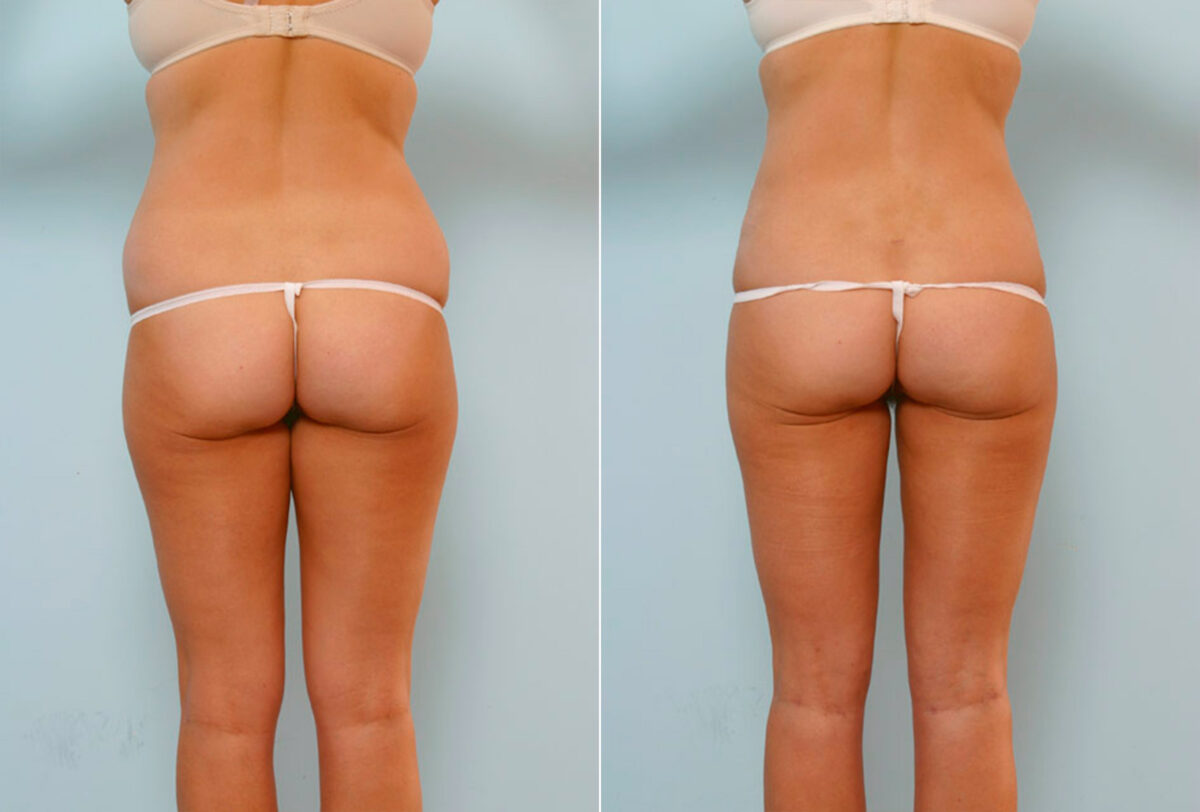 Tummy Tuck/Abdominoplasty before and after photos in Houston, TX, Patient 24480