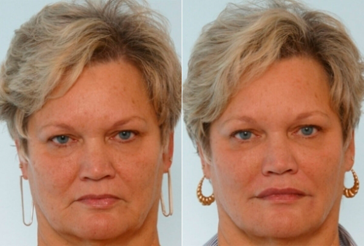 Xeomin / Botox® Cosmetic before and after photos in Houston, TX, Patient 27077