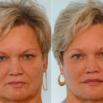 Botox® Cosmetic before and after photos in Houston, TX, Patient 27077