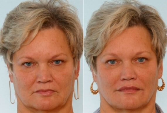 Xeomin / Botox® Cosmetic before and after photos in Houston, TX, Patient 27077