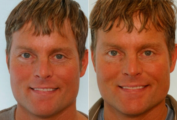 Xeomin / Botox® Cosmetic before and after photos in Houston, TX, Patient 27080