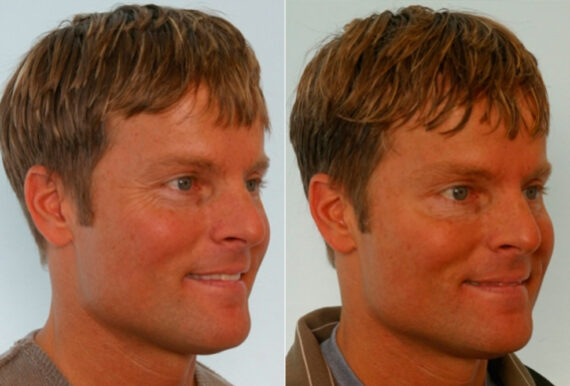 Xeomin / Botox® Cosmetic before and after photos in Houston, TX, Patient 27080