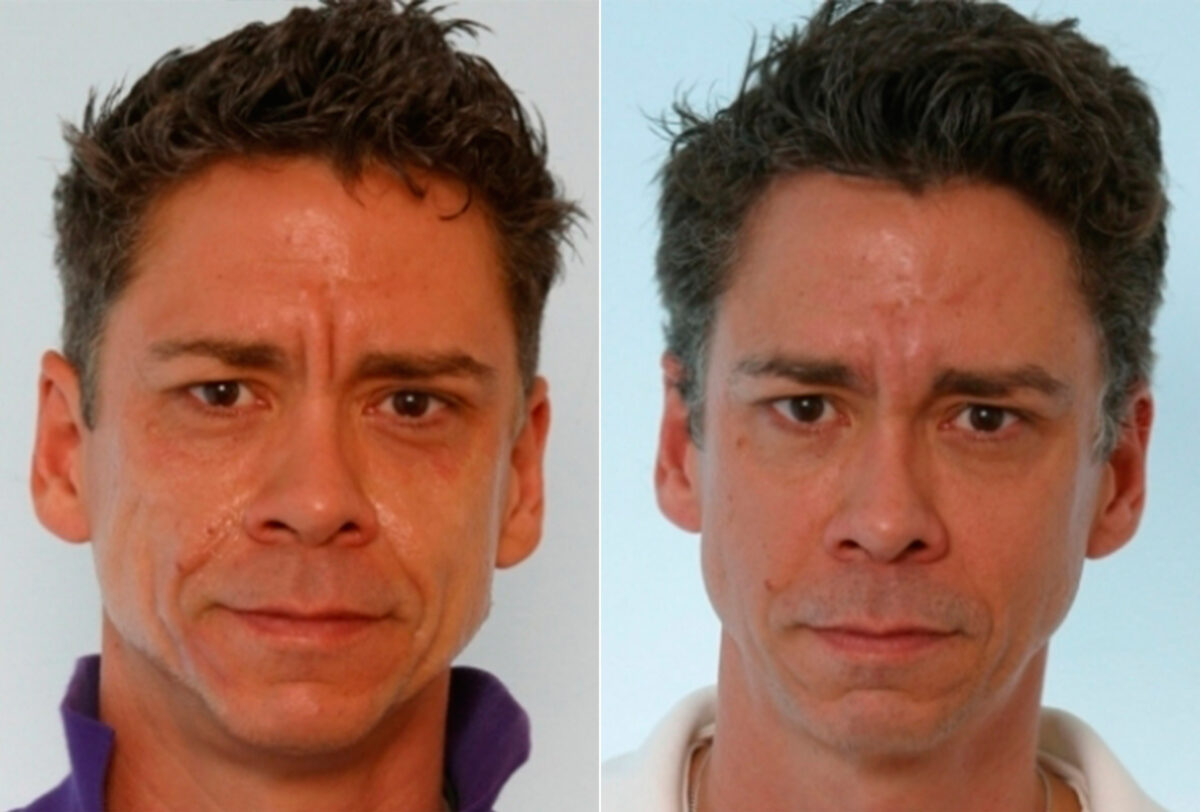Botox® Cosmetic before and after photos in Houston, TX, Patient 27085