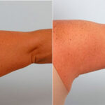 Brachioplasty (Arm Lift) before and after photos in Houston, TX, Patient 27097