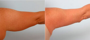 Brachioplasty (Arm Lift) before and after photos in Houston, TX, Patient 27097