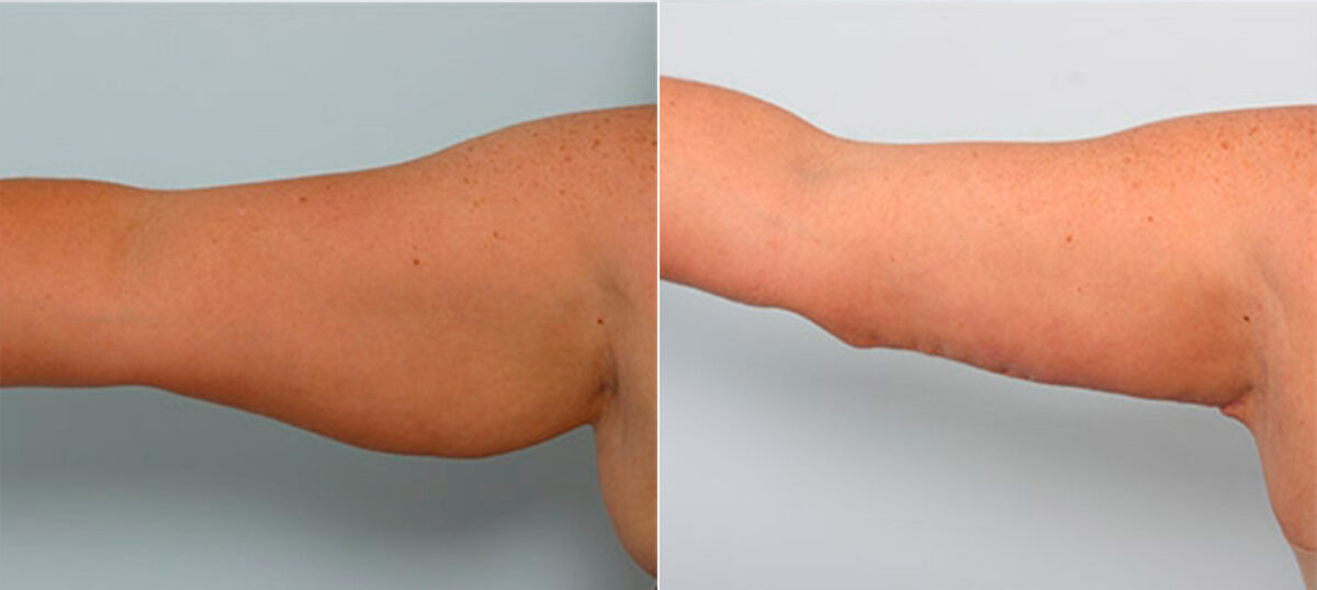 Brachioplasty (Arm Lift) before and after photos in Houston, TX, Patient 27097