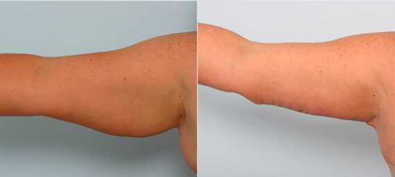 Brachioplasty (Arm Lift) before and after photos in Houston, TX, Patient 27097