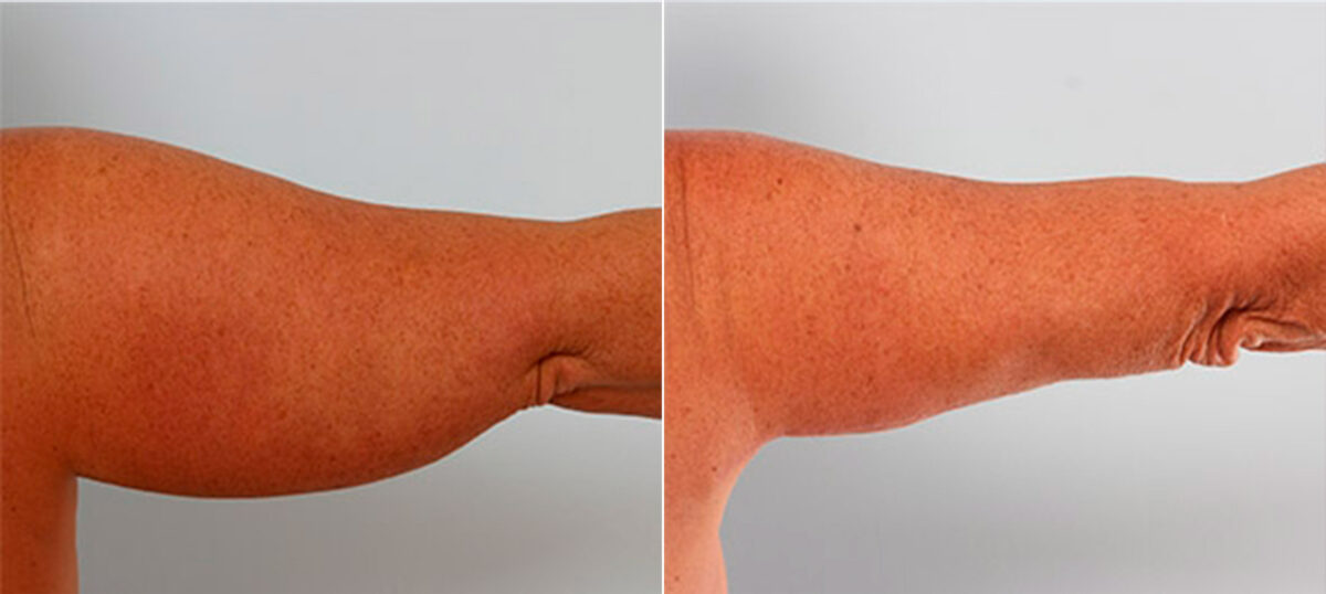 Patient 27102, Brachioplasty (Arm Lift) before and after photos Brachioplasty (Arm Lift) before and after photos in Houston, TX, Patient 27102