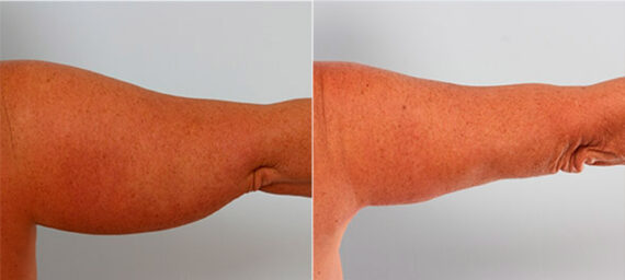 Brachioplasty (Arm Lift) before and after photos in Houston, TX, Patient 27102