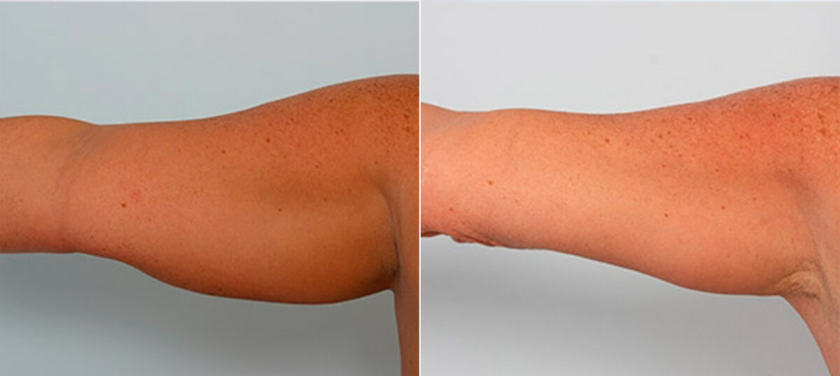 Brachioplasty (Arm Lift) before and after photos in Houston, TX, Patient 27102