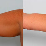 Brachioplasty (Arm Lift) before and after photos in Houston, TX, Patient 27102