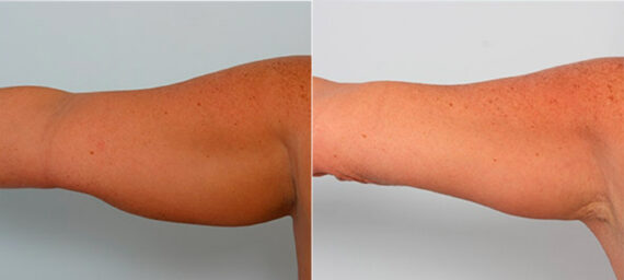 Brachioplasty (Arm Lift) before and after photos in Houston, TX, Patient 27102
