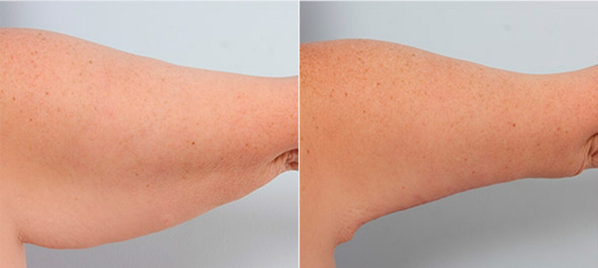 Brachioplasty (Arm Lift) before and after photos in Houston, TX, Patient 27107