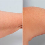 Brachioplasty (Arm Lift) before and after photos in Houston, TX, Patient 27107