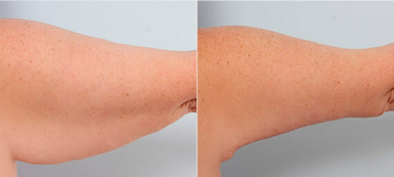 Brachioplasty (Arm Lift) before and after photos in Houston, TX, Patient 27107