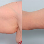 Brachioplasty (Arm Lift) before and after photos in Houston, TX, Patient 27107