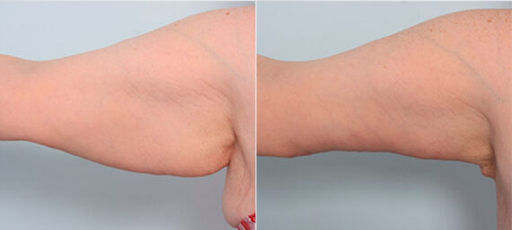 Brachioplasty (Arm Lift) before and after photos in Houston, TX, Patient 27107
