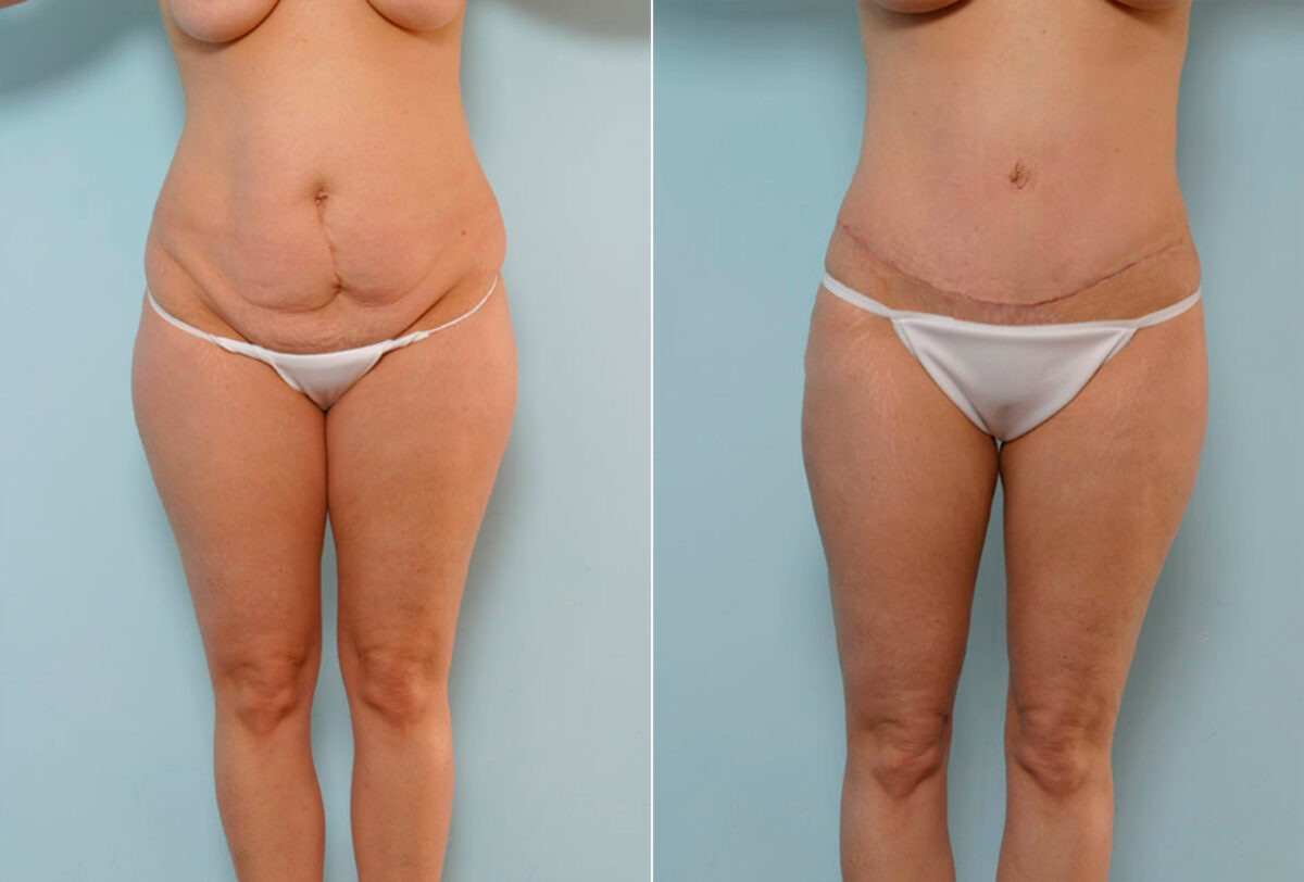 Abdominoplasty before and after photos in Houston, TX, Patient 24487