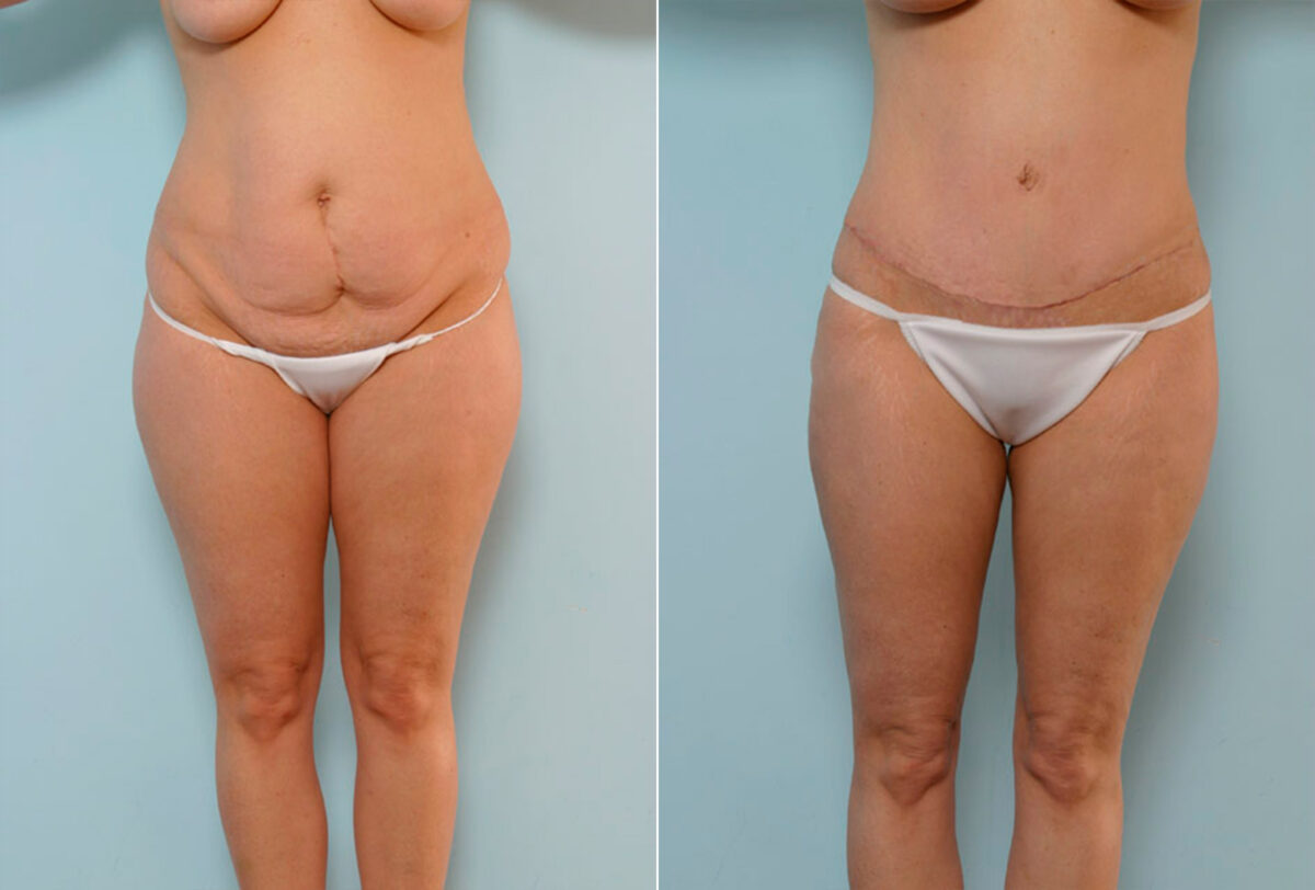 Patient 24487, Tummy Tuck/Abdominoplasty before and after photos Tummy Tuck/Abdominoplasty before and after photos in Houston, TX, Patient 24487