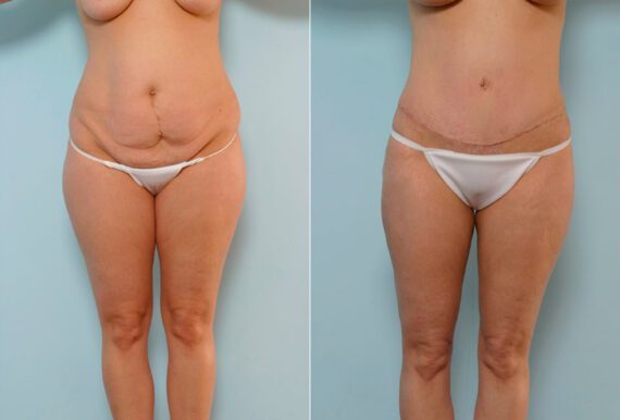 Abdominoplasty before and after photos in Houston, TX, Patient 24487