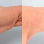 Brachioplasty (Arm Lift) before and after photos in Houston, TX, Patient 27112