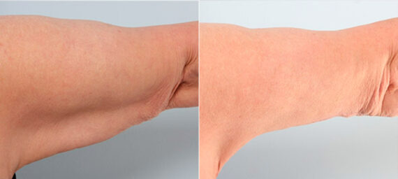 Brachioplasty (Arm Lift) before and after photos in Houston, TX, Patient 27112