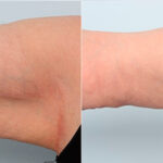 Brachioplasty (Arm Lift) before and after photos in Houston, TX, Patient 27112