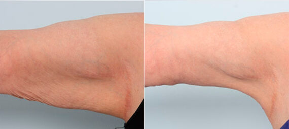 Brachioplasty (Arm Lift) before and after photos in Houston, TX, Patient 27112