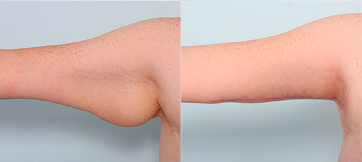 Brachioplasty (Arm Lift) before and after photos in Houston, TX, Patient 27117