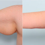 Brachioplasty (Arm Lift) before and after photos in Houston, TX, Patient 27117