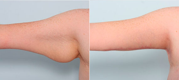Brachioplasty (Arm Lift) before and after photos in Houston, TX, Patient 27117