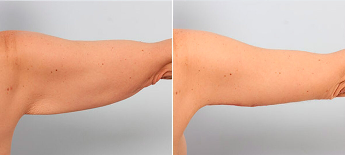 Brachioplasty (Arm Lift) before and after photos in Houston, TX, Patient 27122