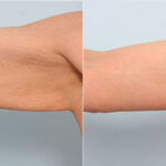 Brachioplasty (Arm Lift) before and after photos in Houston, TX, Patient 27122