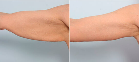 Brachioplasty (Arm Lift) before and after photos in Houston, TX, Patient 27122