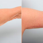Brachioplasty (Arm Lift) before and after photos in Houston, TX, Patient 27127